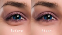 Dark Circles around Eyes – Reasons and Effective Means of Battle
